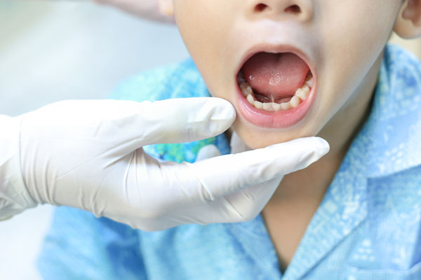 MFT（口腔筋機能療法）