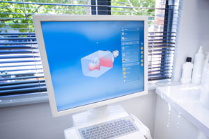 iTeroスキャン＆リスク評価