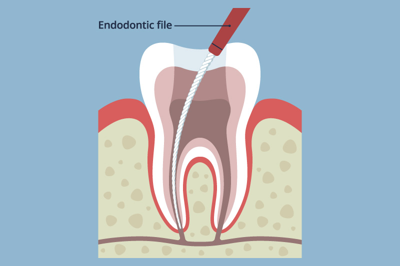 超弾性ニッケルチタンファイル