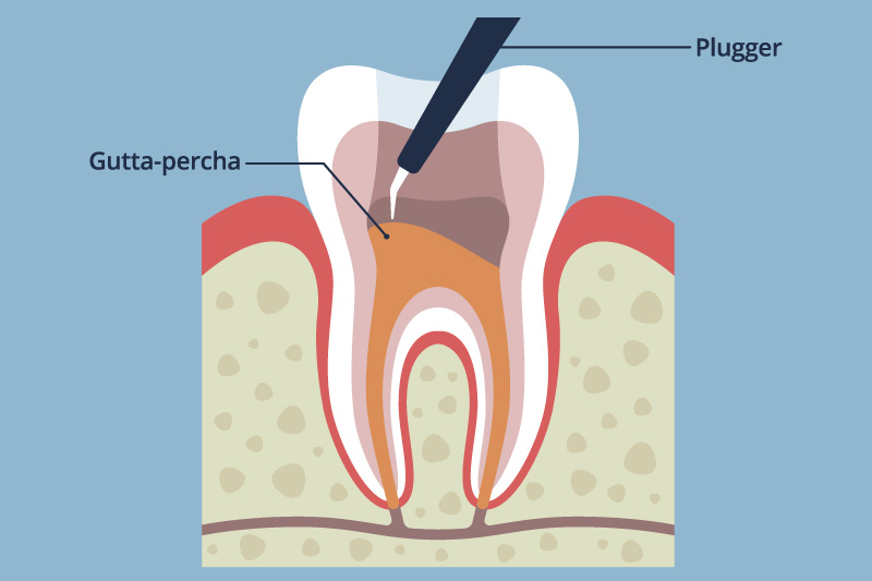 根管治療専用超音波チップ