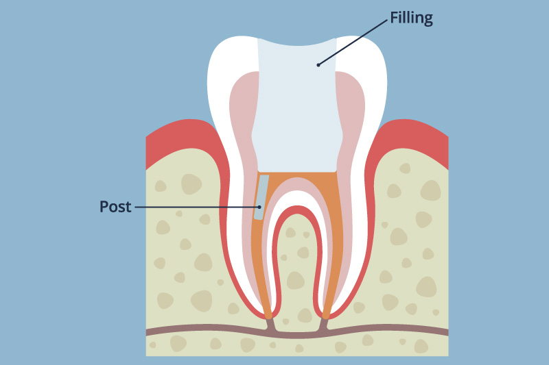 化学的根管洗浄