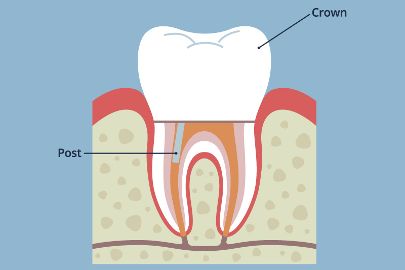 バイオセラミックセメント（MTA）封鎖